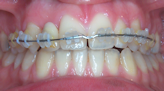 appareil orthodontie