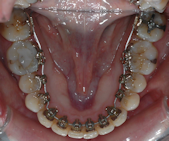 appareil amovible orthodontie